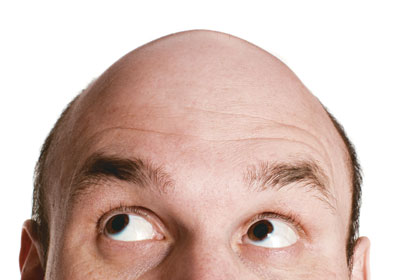 O que Fazer para não Ficar Careca – Saiba como Prevenir a Calvície