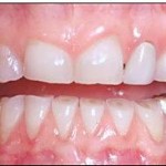 bruxismo-dentes-gastos