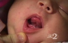 Bebê Nasce com Dois Dentes na Flórida, Estados Unidos – Veja Foto