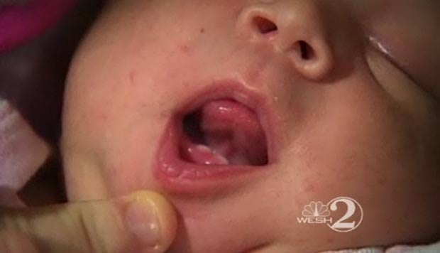 Bebê Nasce com Dois Dentes na Flórida, Estados Unidos – Veja Foto