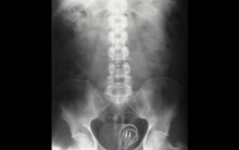 Imagens de Raio X Curiosos: Objetos Encontrados na Barriga, Estômago