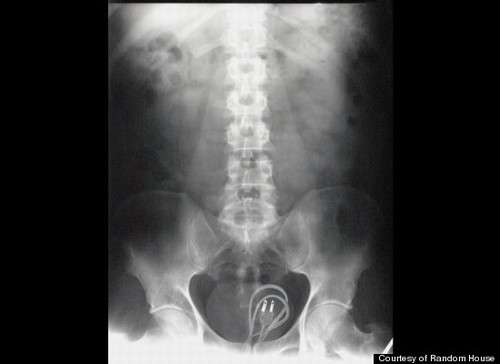 Imagens de Raio X Curiosos: Objetos Encontrados na Barriga, Estômago