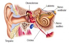 Otosclerose: Entenda o que é, Sinais, Sintomas, Tratamento, Aparelho