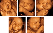 Entenda a Ultrassonografia 4D: Sons e Imagens do Bebê em Tempo Real