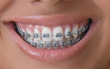 Tipos de Aparelhos Odontológicos: Problemas Dentários, Como Higienizar