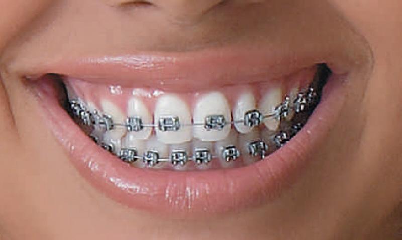Tipos de Aparelhos Odontológicos: Problemas Dentários, Como Higienizar