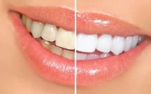 Como Evitar o Escurecimento dos Dentes – Confira Dicas de Clareamento