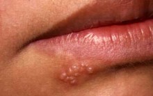 Herpes Labial, Bolhas de Febre – Sintomas, Causas, Cuidados, Prevenção