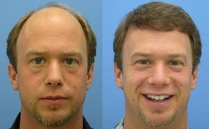 transplante-de-cabelo-quanto-custa-onde-fazer-12-