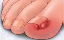Unha Encravada:Sintomas, Tratamento, Como Tirar Unha Encravada dos Pés
