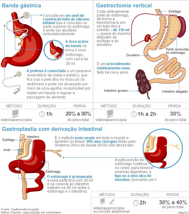 cirugia-para-emagrecer-pelo-sus