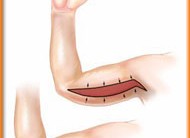 Cirurgia plástica de Braço: Tirar Flacidez com Cirurgia