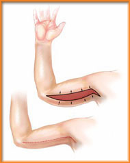 Cirurgia plástica de Braço: Tirar Flacidez com Cirurgia
