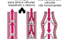 Varizes e Vasos nas Pernas: Causas, Tratamentos, Cuidados e Prevenção