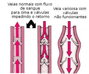 Varizes e Vasos nas Pernas: Causas, Tratamentos, Cuidados e Prevenção