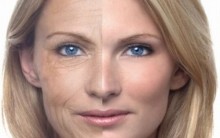 Lifting facial: Anestesia, Procedimento Usado, Tempo de Recuperação