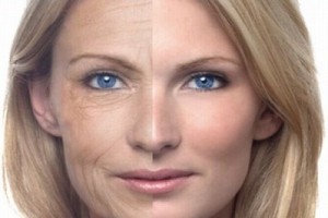 lifting-facial-como-é-feito