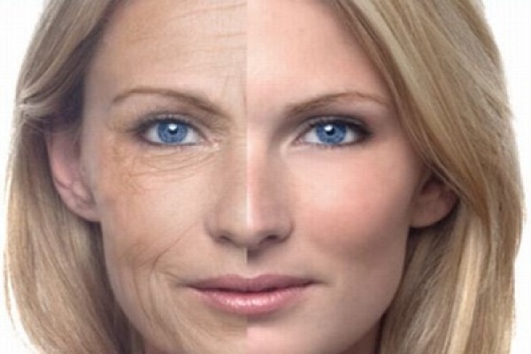 Lifting facial: Anestesia, Procedimento Usado, Tempo de Recuperação