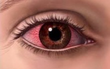 Alergia Ocular – Como Evitar Coceira nos Olhos