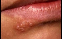 Herpes Simples – Tipos, Cuidados, Causas, Tratamento
