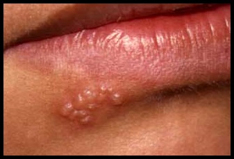Herpes Simples – Tipos, Cuidados, Causas, Tratamento