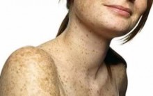 Tratamento Caseiro para Sardas, Manchas e Rugas na Pele