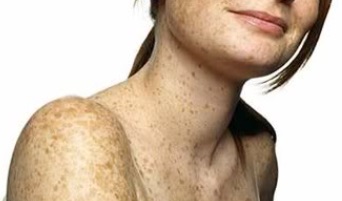 Tratamento Caseiro para Sardas, Manchas e Rugas na Pele