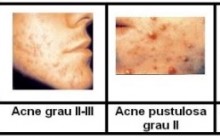Zinco para Tratamento da acne – Dicas de Cuidados da Pele