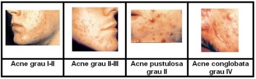 Zinco para Tratamento da acne – Dicas de Cuidados da Pele