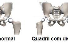 Displasia de Quadril – O Que é e Como Tratar Uma Perna Mais Curta do que a Outra