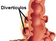 O Que são Divertículos e Diverticulite – Como Prevenir e Dieta para quem tem Divertículos