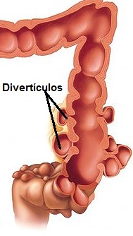 O Que são Divertículos e Diverticulite – Como Prevenir e Dieta para quem tem Divertículos