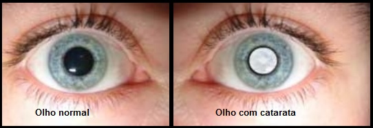 Catarata – Sintomas, Tipos e Causas da Visão Turva, Tratamento e Cirurgia da Catarata