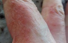 Alergia na Pele – Causas das Alergias nas Mãos, Dermatite de Contato, Chás e Remédios Caseiros