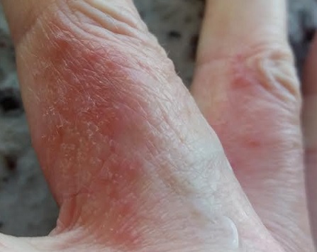 Alergia na Pele – Causas das Alergias nas Mãos, Dermatite de Contato, Chás e Remédios Caseiros