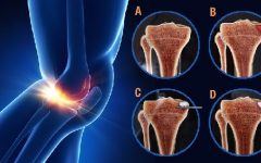 Novo Tratamento para Artrose – Subcondroplastia – Como é Feito e Benefícios