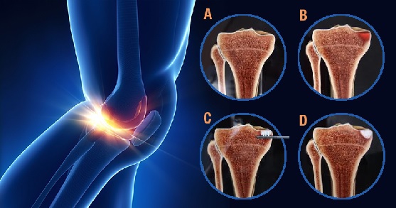 Novo Tratamento para Artrose – Subcondroplastia – Como é Feito e Benefícios