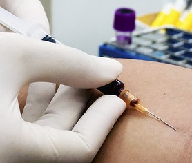 Biópsia Líquida – Exame de Sangue Detecta Câncer na Fase Inicial Afirma Estudos