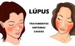 Lúpus: Doença Auto-imune da Selena Gomez, Causa, Sintomas, Tratamento