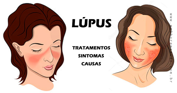 Lúpus: Doença Auto-imune da Selena Gomez, Causa, Sintomas, Tratamento
