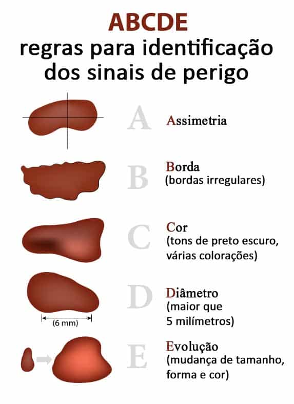 abcde-melanoma
