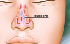 Cirurgia de Septoplastia – Correção de Desvio de Septo, Pré-operatório, Cuidados e Riscos