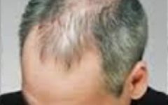 Sandalore Remédio contra Queda de Cabelo e Calvície Ativado por Cheiro