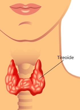Sintomas do Hipertireoidismo – Disfunção da Tireoide, Causas e Tratamento