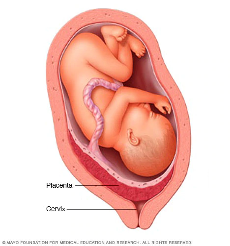Placenta Prévia é Grave? Que é, Sintomas, Tratamento, Riscos para o Bebê