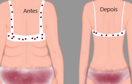 Exercícios Físicos para queimar gordura nas Costas Como Eliminar Pneus
