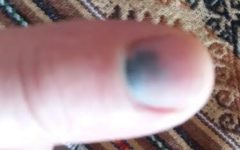 Prendi o Dedo na Porta do Carro Doeu Muito e Ficou Roxo, O Que Fazer?