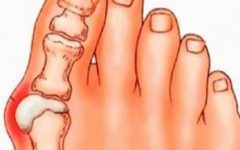 Ácido Úrico Alto – O Que É Hiperuricemia, Causas, Sintomas e Tratamento