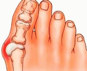 Ácido Úrico Alto – O Que É Hiperuricemia, Causas, Sintomas e Tratamento