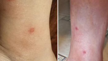 Picada de Butuca pode Inflamar – Sintomas e Cuidados com Mutucas